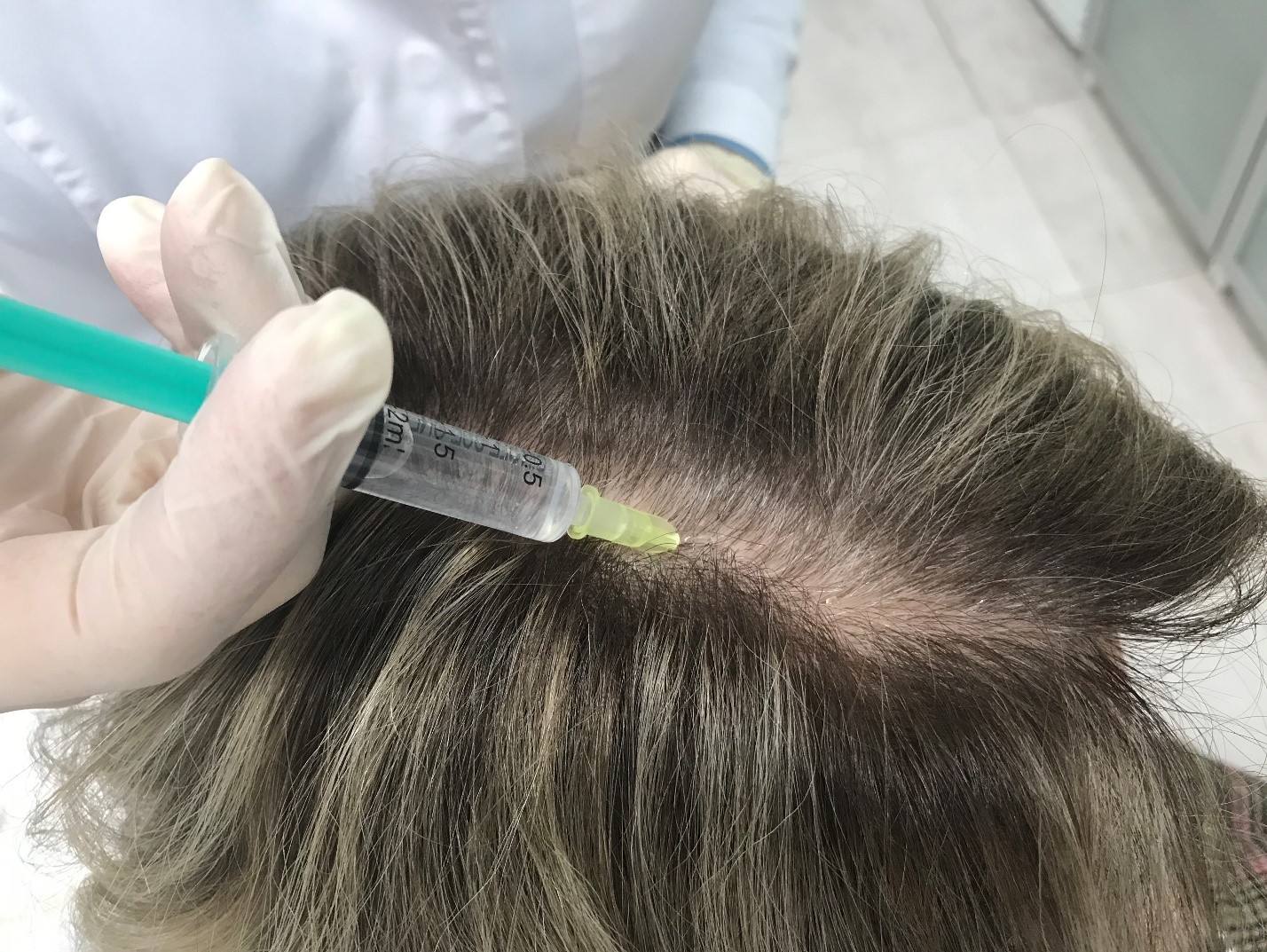 Инъекционные методы лечения выпадения волос