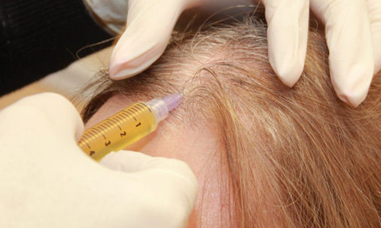 Плазмотерапия – Процедура лечение выпадения волос