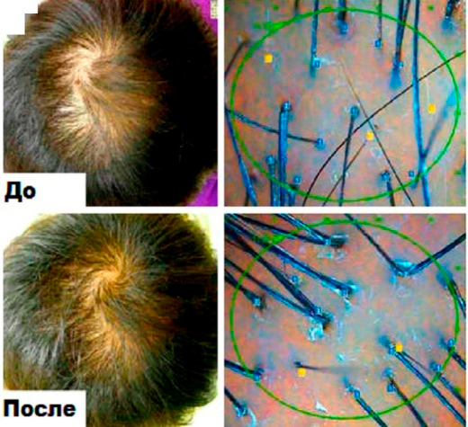 Карбокситерапия – инъекции СО2 для лечения алопеции Результаты