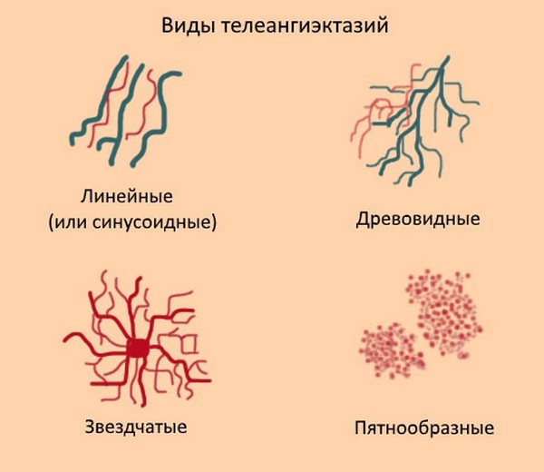 Виды телеангиэктазий