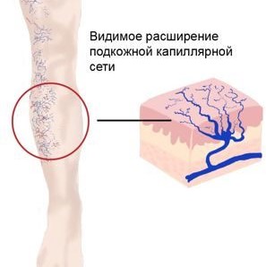 Убрать сосудистую сеточку на лице - 6 эффективных способов.