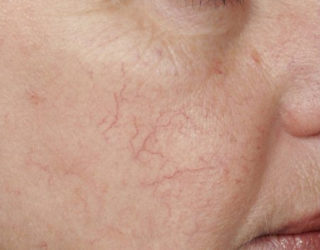 Удаление и лечение купероза на лице до и после