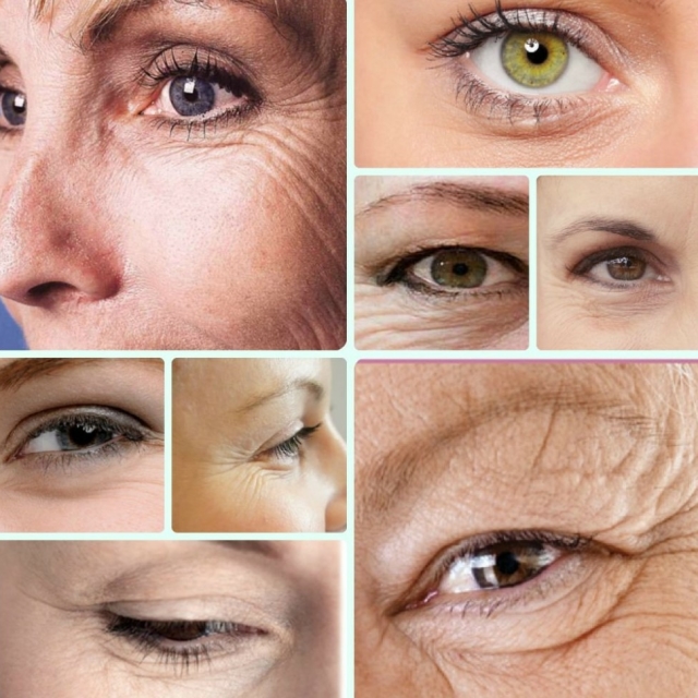 Удаление морщин вокруг глаз в Москве - клиника “Косметомед”